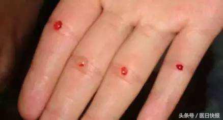 挑治疗法效果如何,民间速效挑点疗法