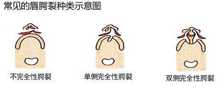 浙江有兔唇修复吗,成年人兔唇疤痕修复