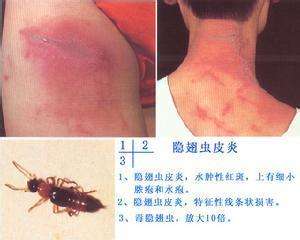 被隐翅虫叮咬后的初步症状,被隐翅虫叮咬之后当时的症状