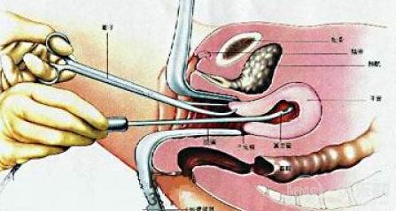 宝宝六个月被引产太可怜了,5个月不想要宝宝引产亲身经历