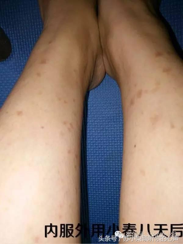 沙棘油，对皮肤还有如此神奇的效果