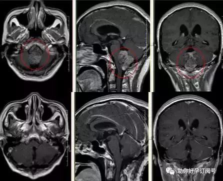 畸胎瘤八大超声征象,畸胎瘤肿瘤五项