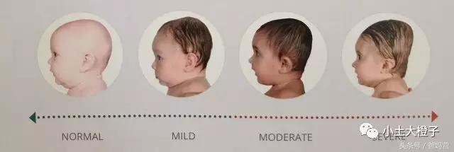 美国的宝宝扁头为什么要矫正,扁头在国外要做矫正吗