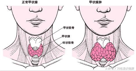 甲亢可怕还是甲减可怕,甲亢并非不治之症