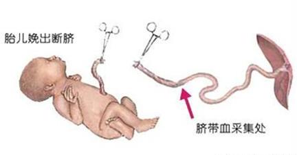 助产士不负责导致胎儿不好,助产士没有接住产道出来的新生儿