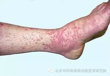 过敏性紫癜如何从根源根治,过敏性紫癜为什么不容易根治
