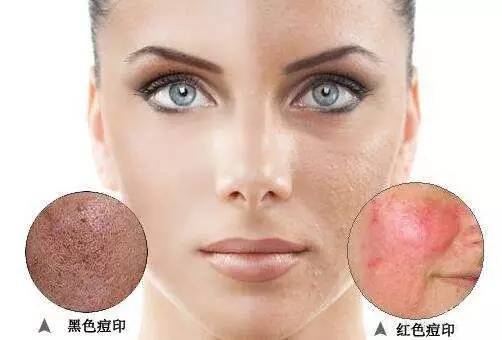 怎么祛痘印最好最快最有效,祛痘印祛斑的最有效的护肤品