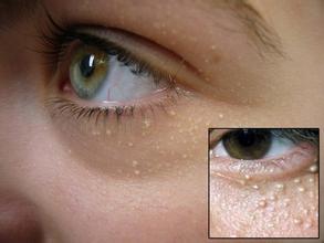 脖子上的脂肪粒消除最快方法,脸上脂肪粒消除最快方法