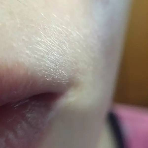 学生党去除唇毛测评,淡化唇毛测评