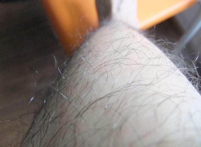 身上长满浓密毛发的“多毛姑娘”,从自卑到逆袭收获爱情