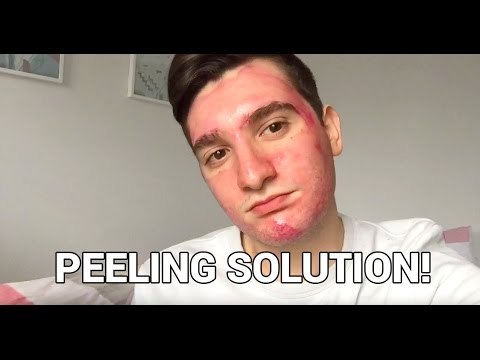 怎样才能祛痘去黑头去闭口,祛痘去黑头粉刺闭口