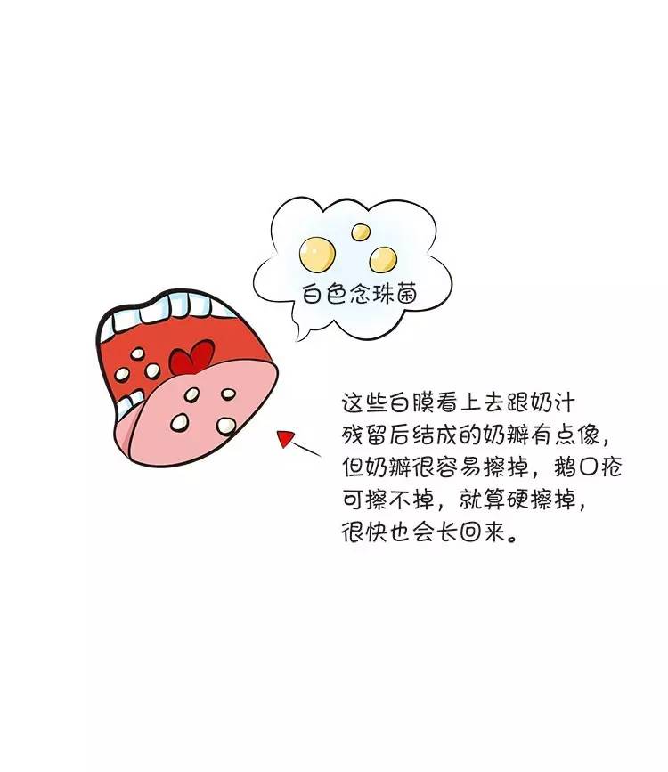 宝宝嘴里有鹅口疮吃奶瓶疼吗,宝宝嘴里长鹅口疮