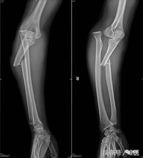 上肢骨折髓内钉恢复后图片,骨折髓内钉自愈的过程