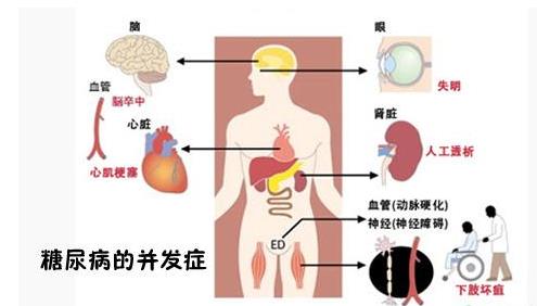 糖尿病不可怕并发症可怕视频,糖尿病综合症和糖尿病并发症