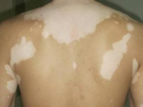 身上长白斑是白癜风吗如何确诊,身上出现白斑都是白癜风吗