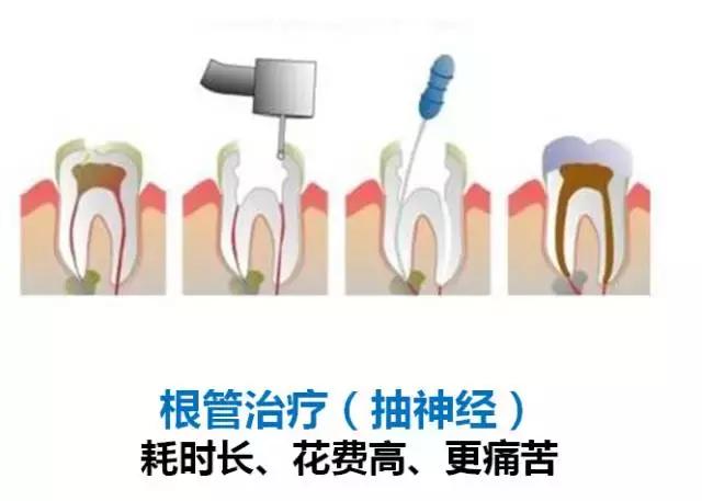 龋齿属于虫牙吗,蛀牙龋齿虫牙是怎么形成的