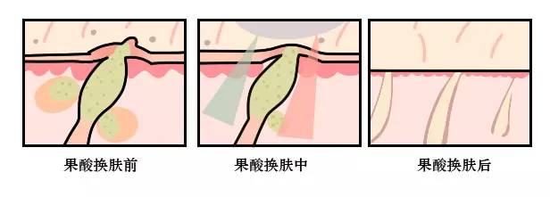 这可能是夏天穿吊带最大的烦恼……这可能是背部痘痘最全攻略