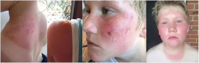 香蕉船防晒霜儿童可以用吗,香蕉船防晒霜用了脸刺痛