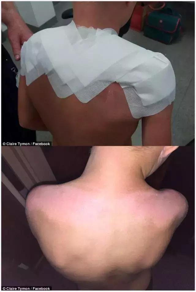 儿童涂防晒霜之前需要涂防晒霜吗,香蕉船防晒霜晒伤事件