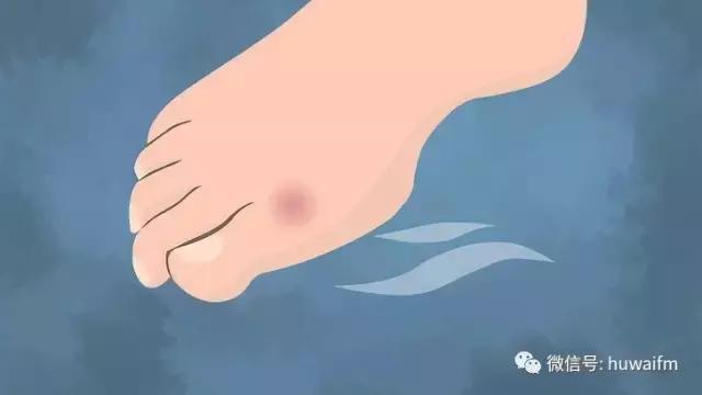 一篇文章看懂你的脚上为什么容易起水泡，起了水泡该怎么办