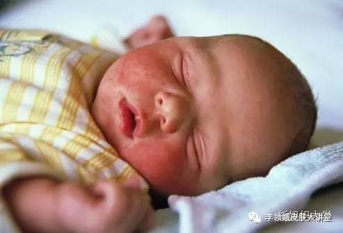 「杏林微科普」如何护理特应性皮炎患儿？