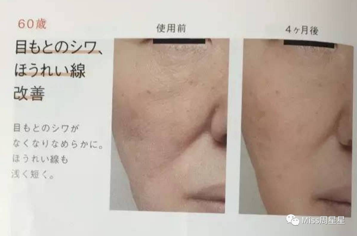 脸部凹陷法令纹用什么美容仪,stop射频美容仪祛法令纹