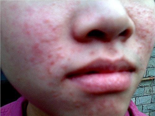 祛痘很多次都不见效,祛痘一瓶搞定