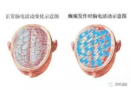 可视性癫痫,可诱发癫痫的药物有哪些