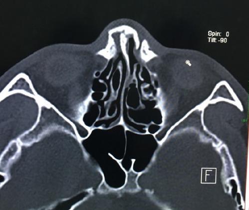 一龙打硬功,一龙成名铁头功