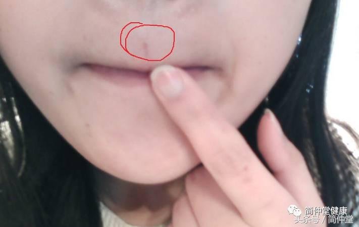 人中上长了个硬痘还疼,人中旁长痘预示着什么