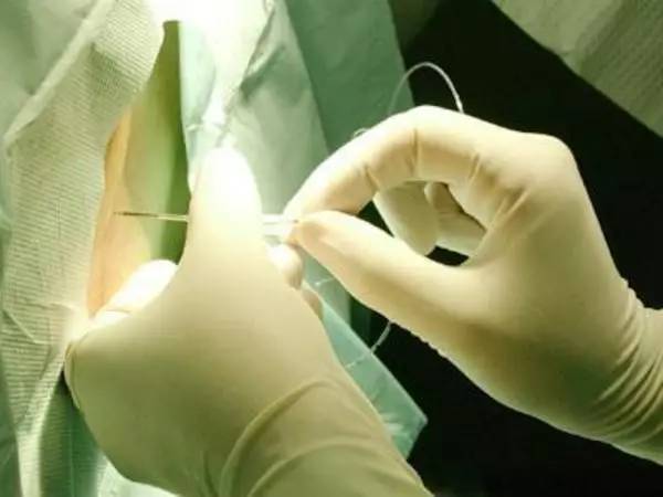 郑宏：凝血功能障碍与剖宫产手术麻醉