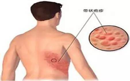 蛇串疮西医病名,蛇串疮医术专长综述范文