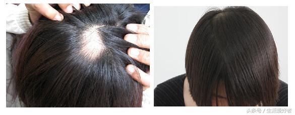 生发止脱发最快的方法,脱发剃光头用什么方法能生发