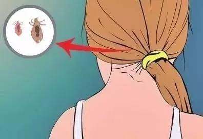 孩子头发有头皮屑原因,孩子头发痒有头皮屑怎么办