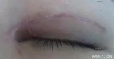 闺蜜割了双眼皮,割了双眼皮后悔了一个月