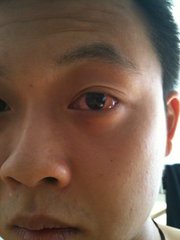 肝有问题身体出现的十种不适症状,6个症状说明你的肝出问题了