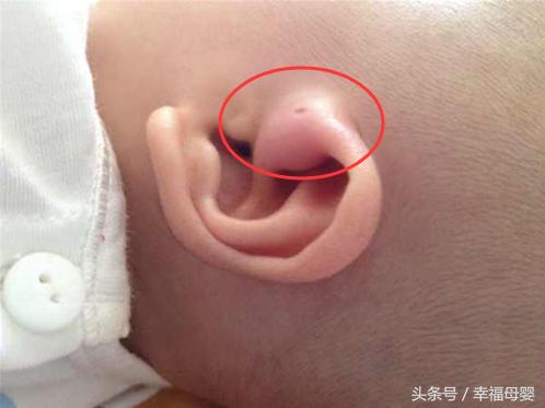 宝宝耳朵内侧有个小针眼洞,两个月的宝宝左耳耳前瘘管