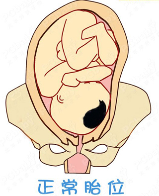 37周胎位不正脐带绕颈1周怎么矫正,胎位不正怎么纠正最快注意事项