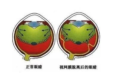 视网膜脱落严重吗,视网膜脱离属于眼部的什么疾病