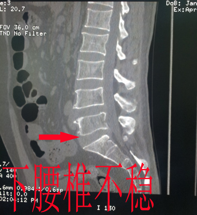 一看就懂：高清视频详细解剖腰椎结构，腰椎各疾病