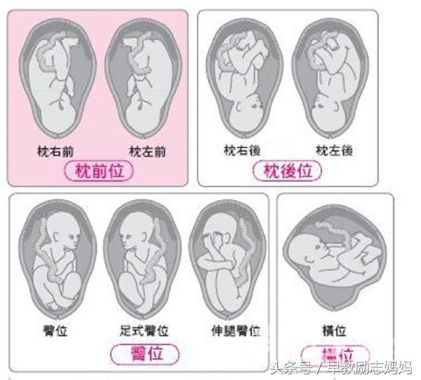 胎位不正的原因和预防方法,第一胎胎位不正第二胎也胎位不正