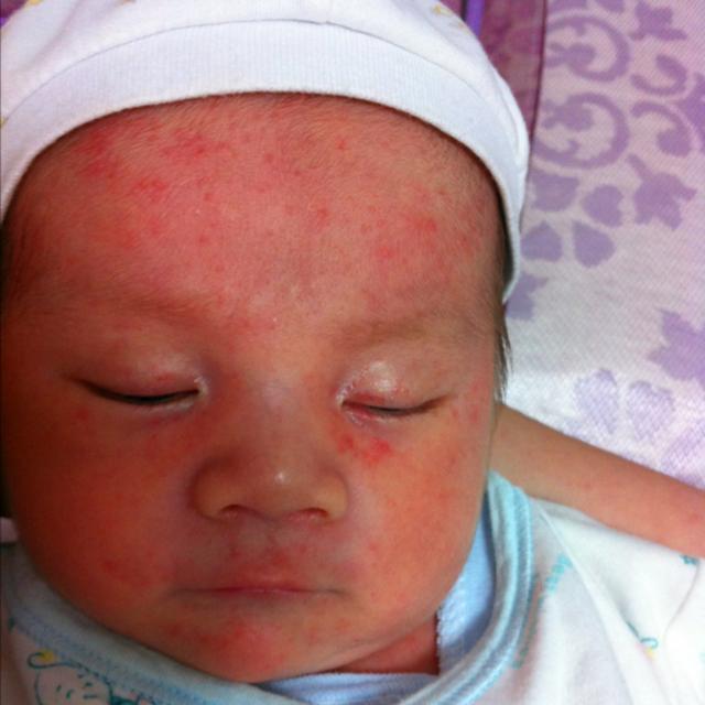 宝宝长痱子用什么方法最有效,预防宝宝长痱子用什么方法最有效