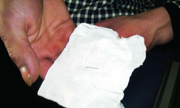 2岁宝宝走路一瘸一拐，医生竟从宝宝脚底取出一根针！