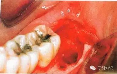 口腔拔牙图片,口腔拔牙麻醉多久消退