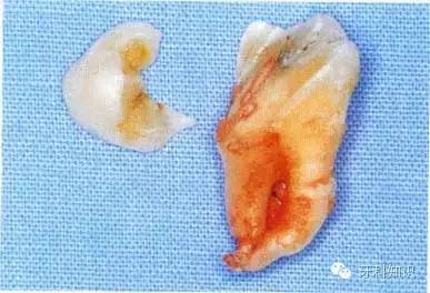 口腔拔牙图片,口腔拔牙麻醉多久消退