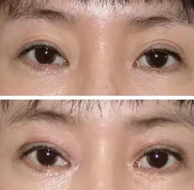 拯救三眼皮的方法,术后出现三眼皮算手术失败吗