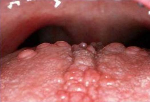 口腔里的“假癌症”(口腔科普第21期)