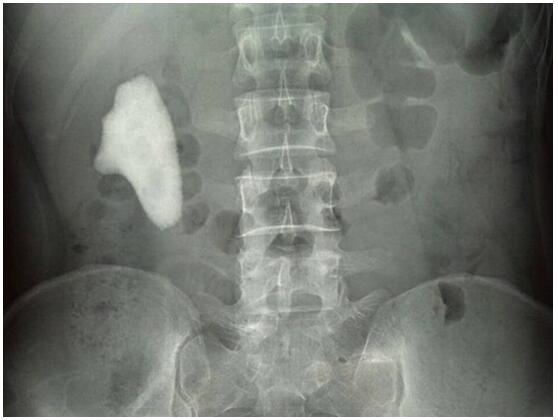 罕见!博锐医院取出像“7”又像“1”的巨大结石