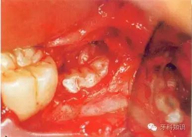 口腔拔牙图片,口腔拔牙麻醉多久消退