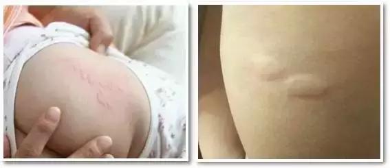 痱子不小心当湿疹治疗会怎么样,痱子小红点